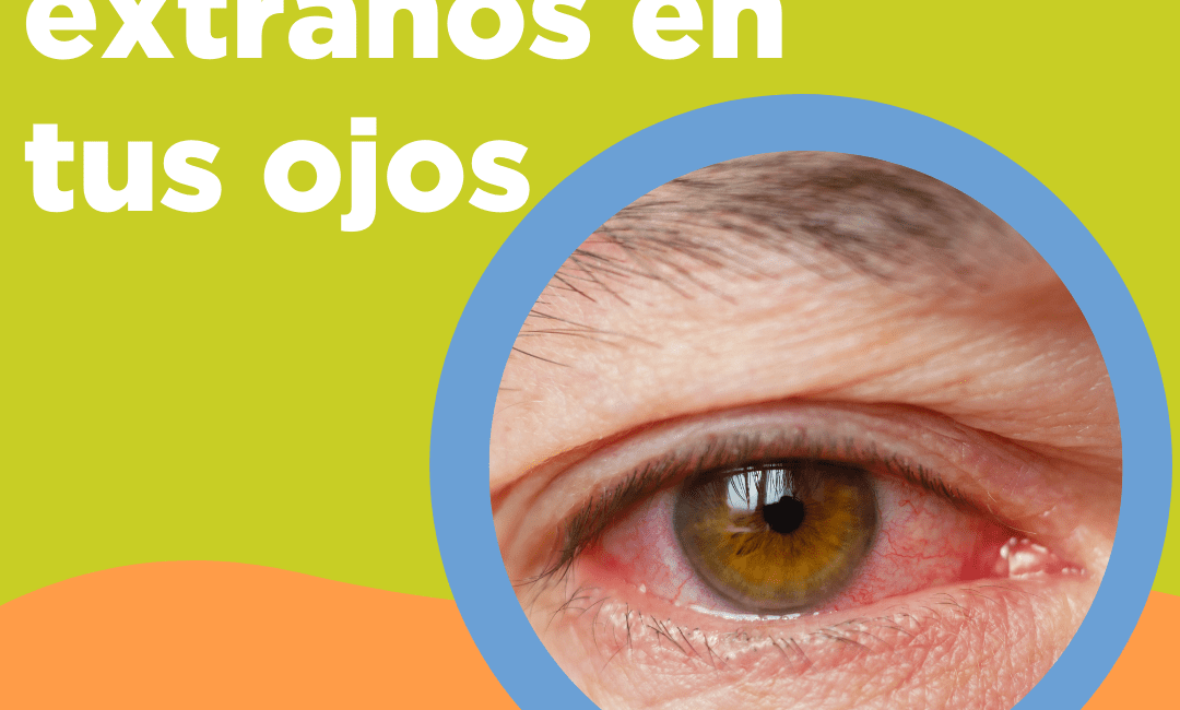 Cuerpos extraños en el ojo Óptica Colombiana